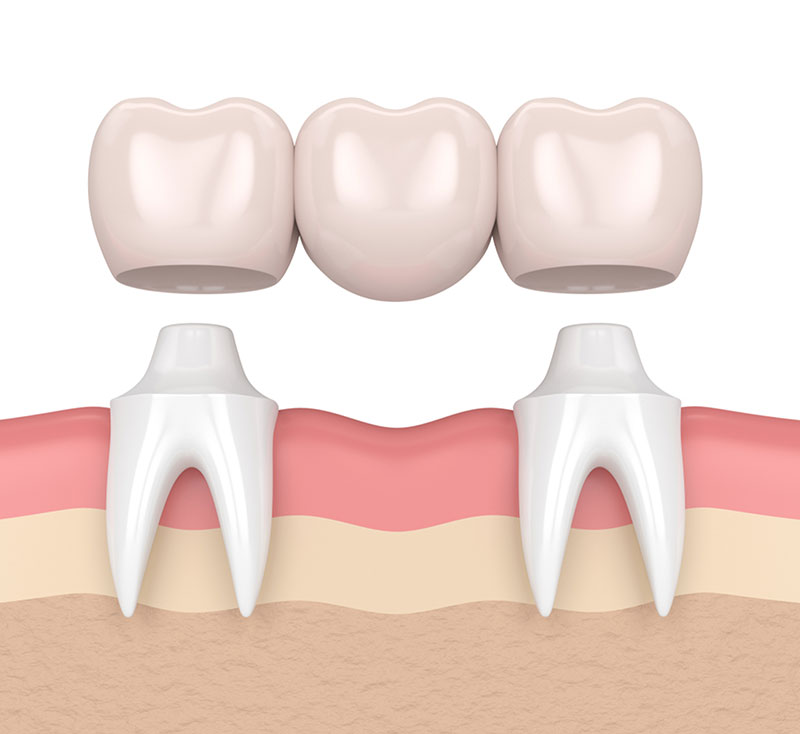 dental bridges in grande prairie