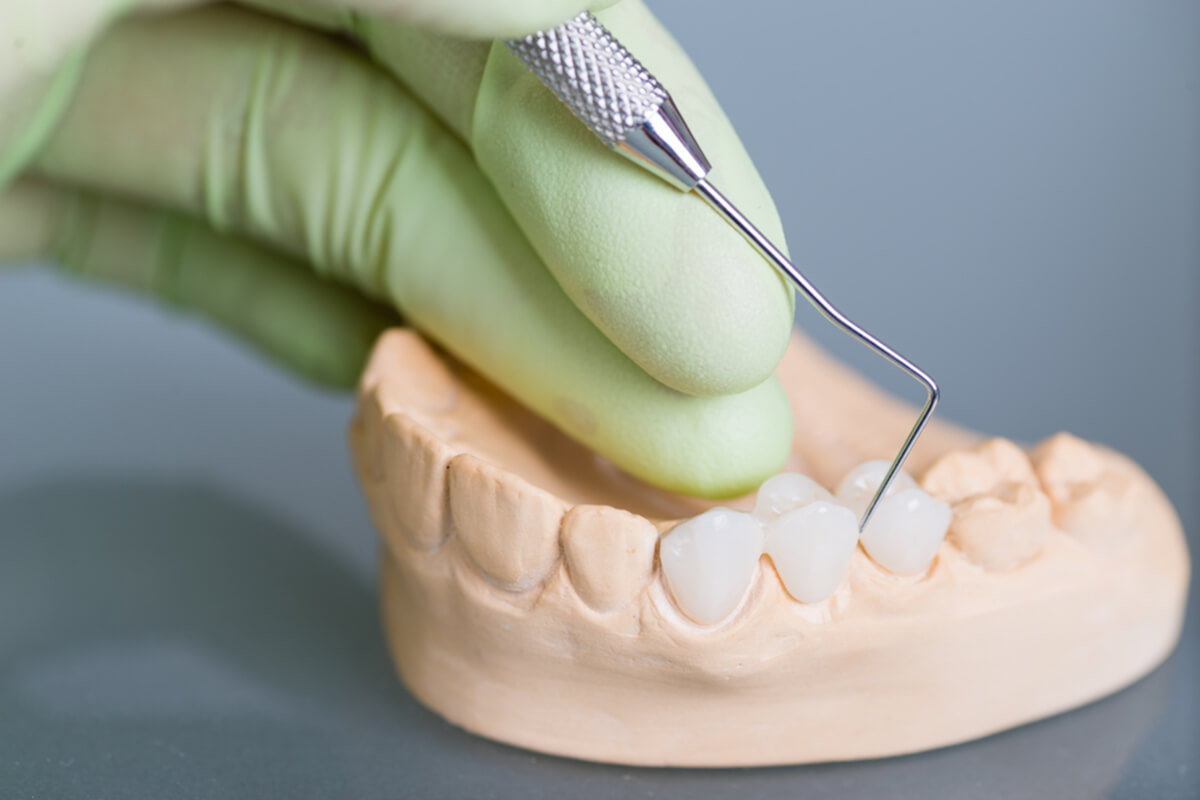5 essential things to know about dental bridges