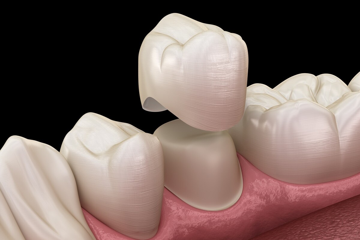 the benefits of dental crowns for restoring your smile