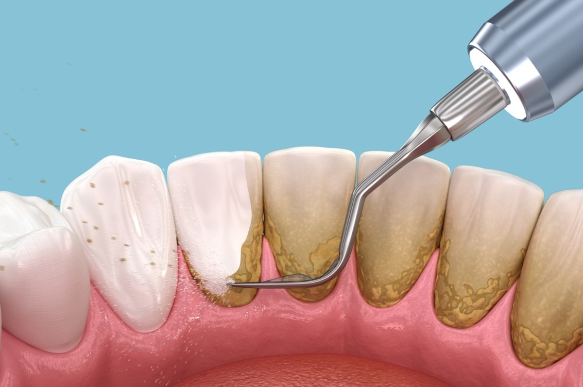what is plaque and why it s bad for your teeth