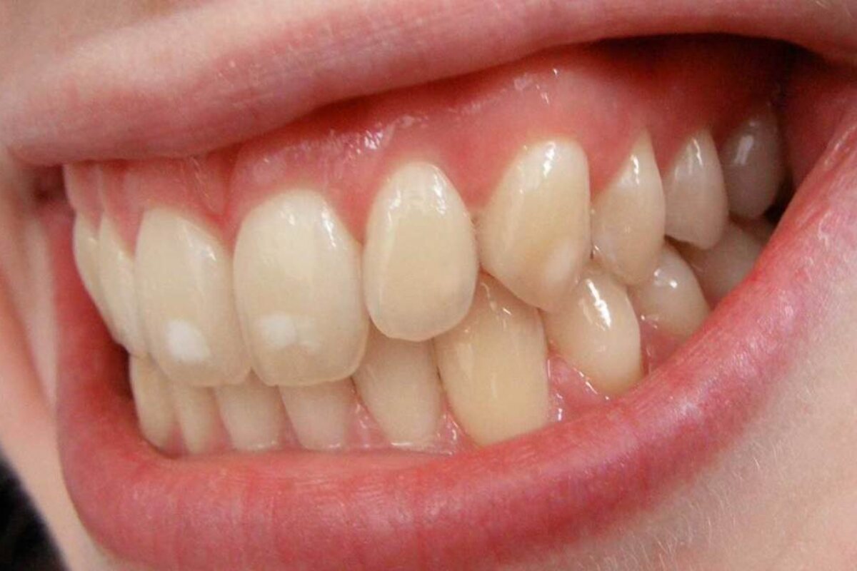 white spots on teeth causes and treatment options