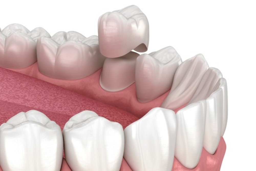 Are Dental Crowns Permanent? What Affects Their Lifespan
